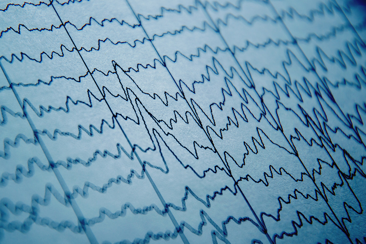 Brain wave patterns on electroencephalogram