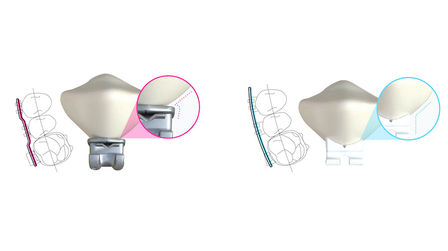 LightForce's 3D-printed brackets and trays can be adhered right to the patient's teeth and are made with similar materials to traditional brackets